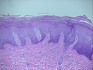 non-bullous congenital ichthyosiform erythroderma