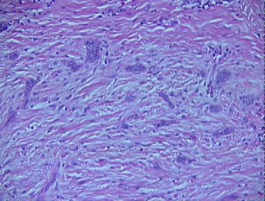 Basal Cell Carcinoma Histology Features