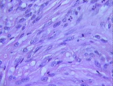 spindle cell squamous cell carcinoma
