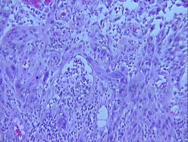 spindle cell melanoma, ulcerated