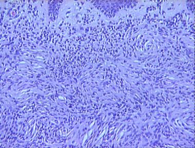 spindle cell nevus