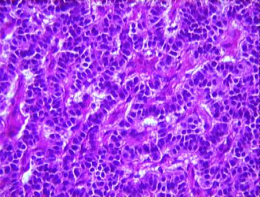 metastatic carcinoid tumor