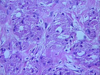 granular cell tumor